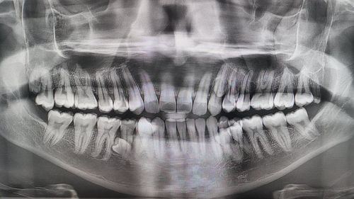 luar biasa! lelaki malaysia jadi pemegang rekod dunia dengan 42 batang gigi dalam mulut